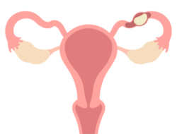illustration of an ectopic pregnancy in the fallopian tubes